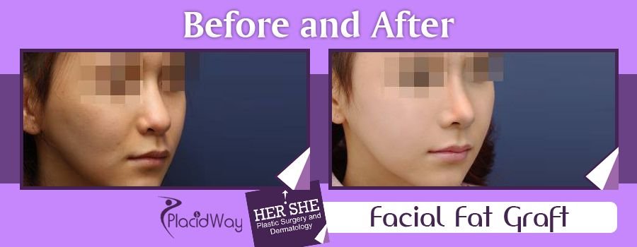 Facial Fat Graft Before and After Images South Korea